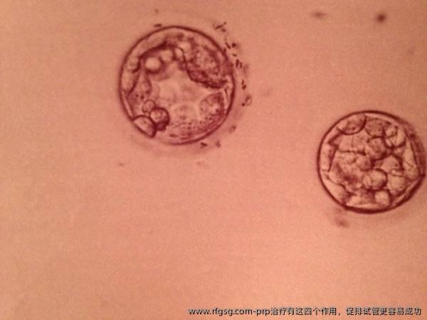 prp治疗有这四个作用，促排试管更容易成功