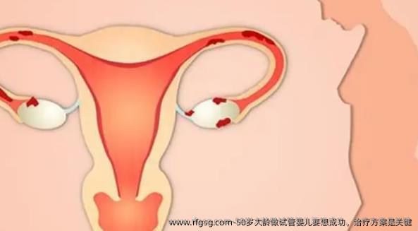 50岁大龄做试管婴儿要想成功，治疗方案是关键