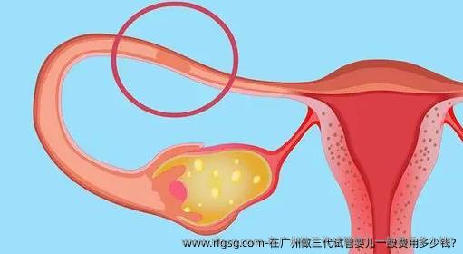 在广州做三代试管婴儿一般费用多少钱?