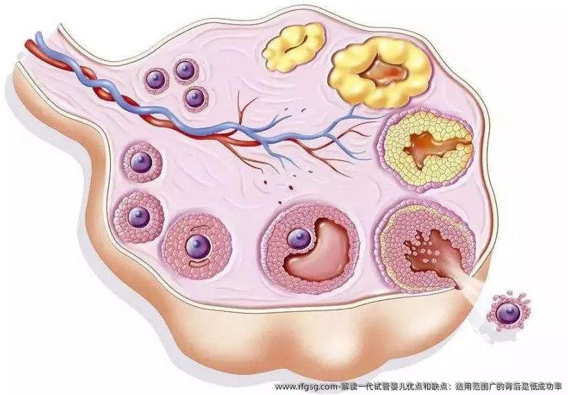 解读一代试管婴儿优点和缺点：适用范围广的背后是低成功率