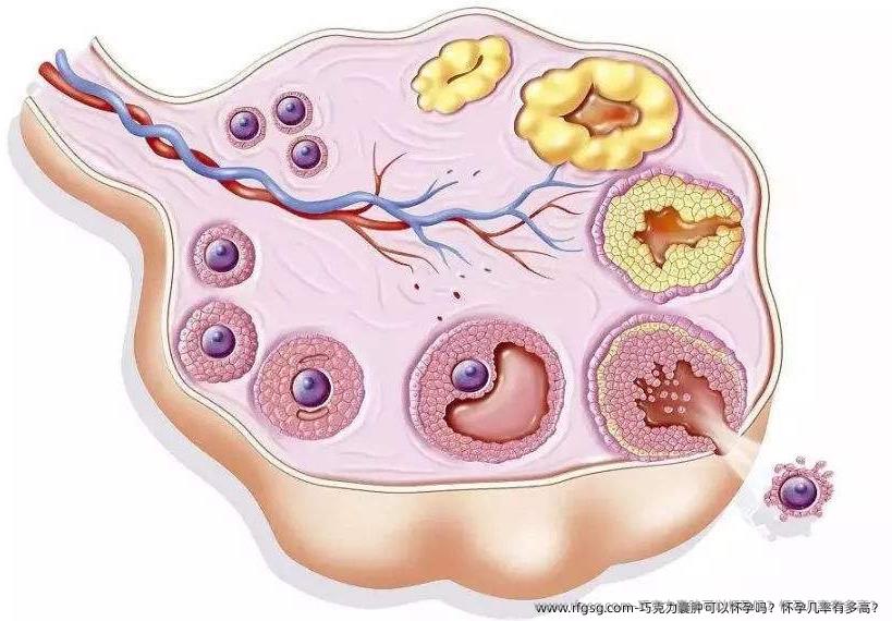 巧克力囊肿可以怀孕吗？怀孕几率有多高？