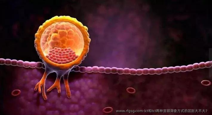 lct和tct两种宫颈筛查方式的区别大不大？